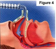 Snoring Treatment by ENT Doctor